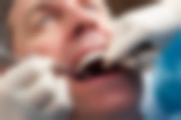 蛀牙的根管治疗究竟有何必要性？深入探讨根管治疗对牙齿健康的重要性。