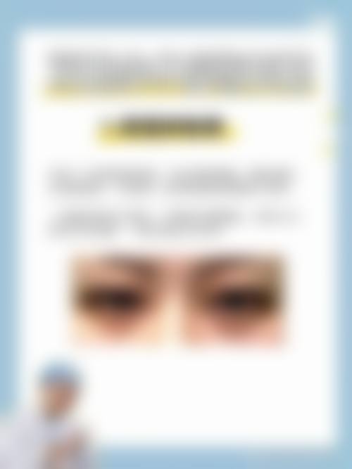 南宁微美周志华做全切双眼皮手术过程揭秘