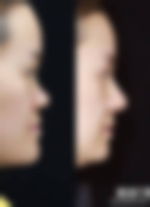 大连爱德丽格医美韩士生科硅胶假体隆鼻的预约挂号方式