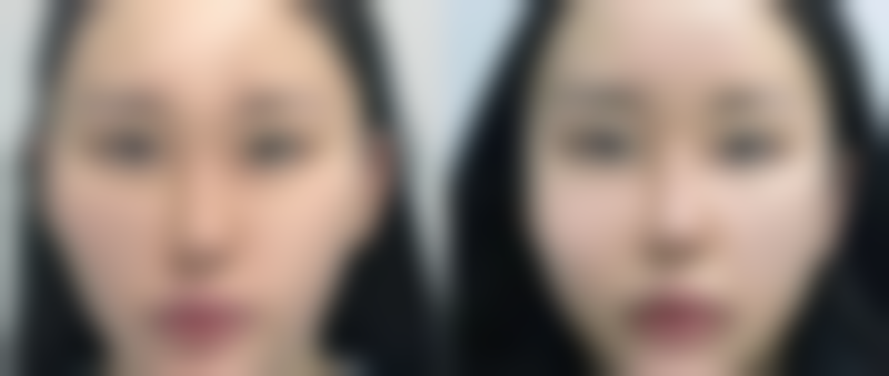 术后修复，惊喜不断