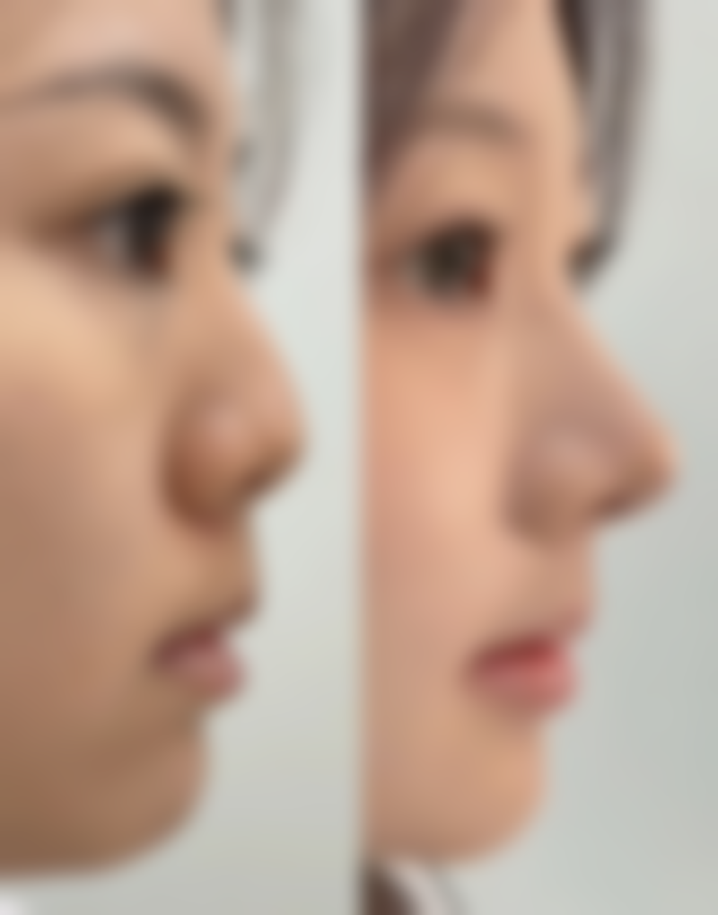 大连爱德丽格医美韩士生科硅胶假体隆鼻的实例展示