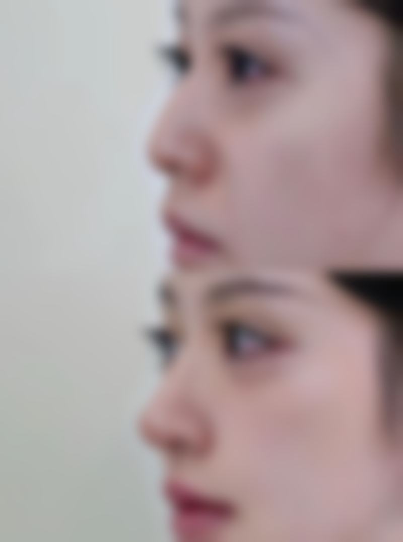 大连爱德丽格医美韩士生科硅胶假体隆鼻1880元起，用亲民价格+先进技术，让你轻松拥有自然美鼻开启变美之旅！ 