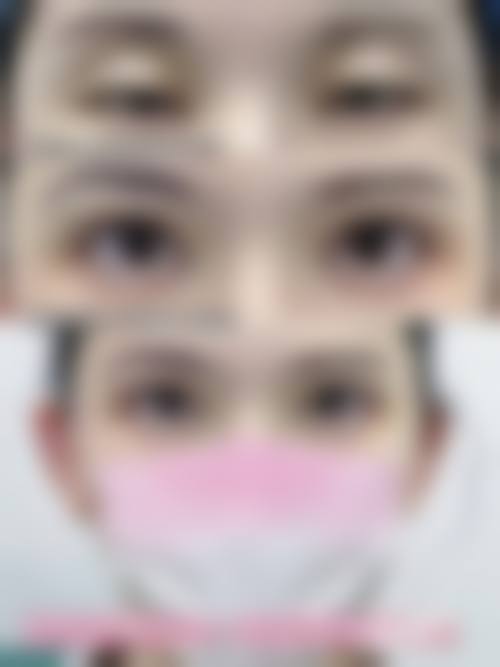 大连爱德丽格医美切开双眼皮价格1835元起预约挂号方式