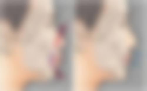 国产瘦脸针有用吗？权威数据揭秘其90%有效率，多案例见证安全变美效果！ 