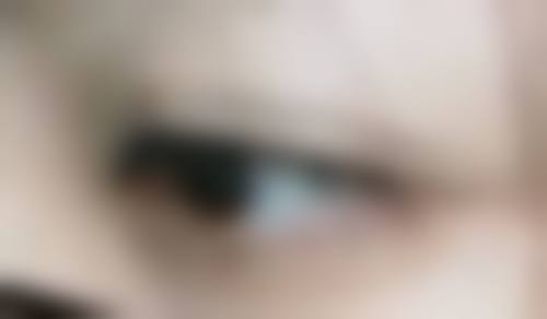 头发种植术植发一般价格