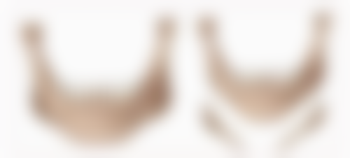 头发种植术成效怎么样