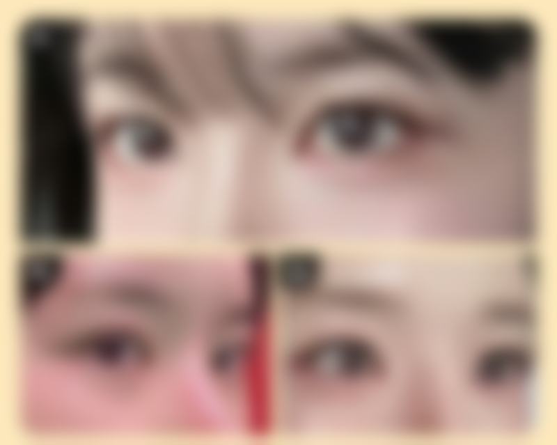 打完溶脂和瘦脸注意事项