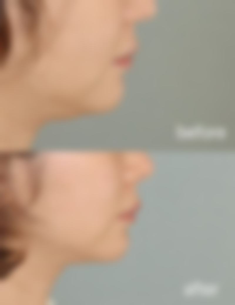 打完溶脂和瘦脸针多久能化妆