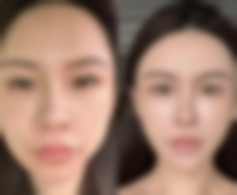 瘦脸针多久打一次成效至佳