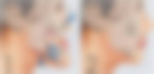 上嘴唇翘的纠正方法