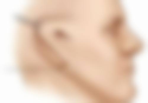 经常打除皱针对皮肤有伤害吗