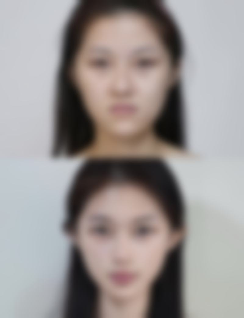 瘦脸针打几次就不用再打了？