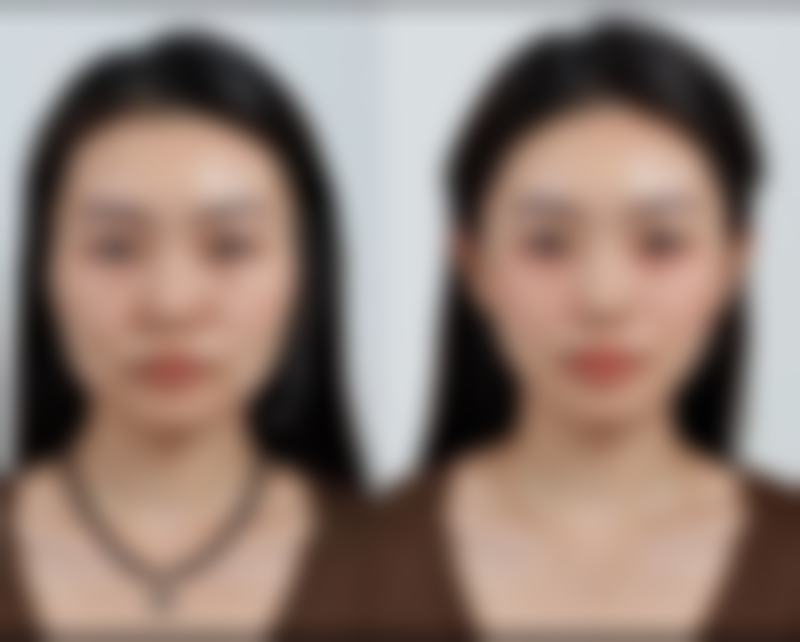 苹果肌能打溶脂针吗？