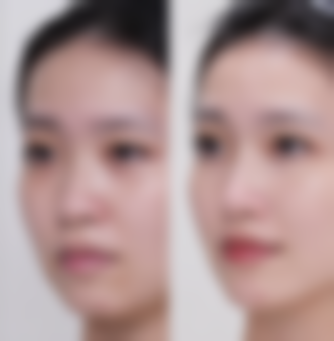 瘦脸针打完多久见效