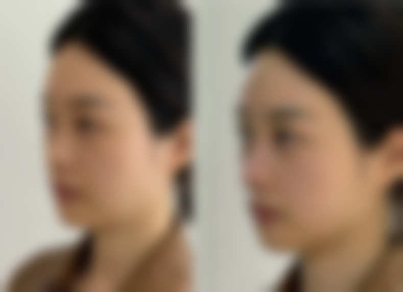 第一次打瘦脸针能维持多久