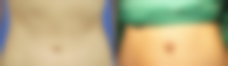 打瘦脸针的注意事项