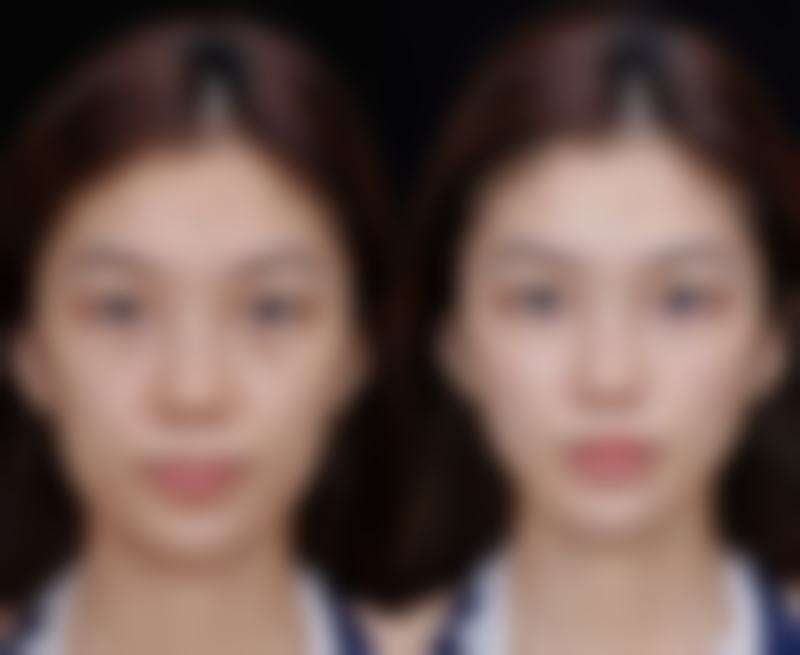 打瘦脸针有成效吗？