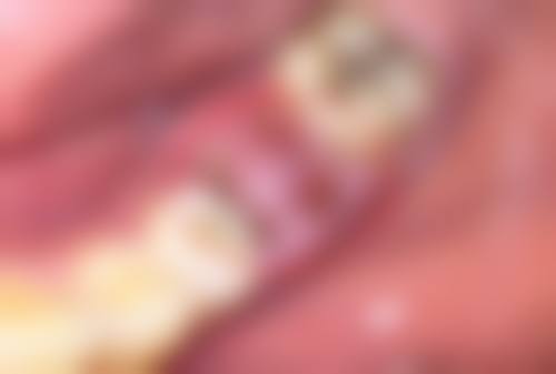 拉皮手术多久能修复正常