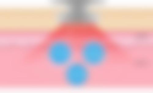 打瘦脸针的价格