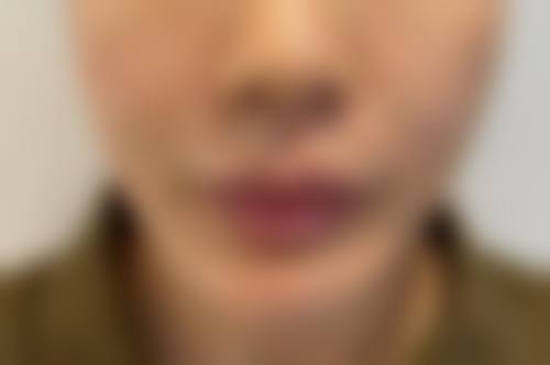 患者A：“我在成都新颐美整形医院做了面部年轻化的项目，成效真的太棒了！姚佳妮医生特别专精，术前跟我沟通得特别详细，根据我的皮肤状况制定了合适的方案。术后我的皮肤变得紧致有弹性，整个人看起来年轻了好几岁，而且医护人员的服务也特别周到，会经常关心我的修复情况，我特别满意这次体验。”