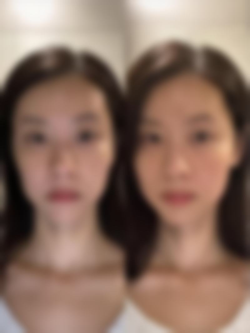 唇部整形手术的成效怎么样图片