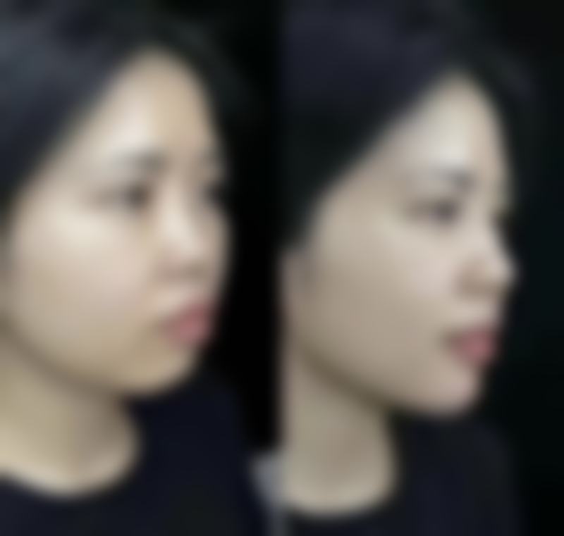 唇、腭裂及唇裂术后明显瘢痕 不合格