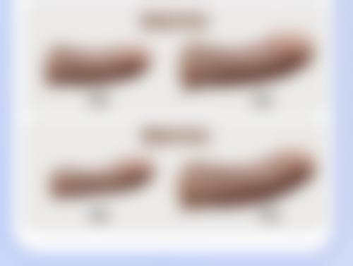 牙齿矫正可以只矫正上排牙吗