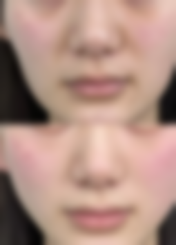 种的毛囊能坚持多久