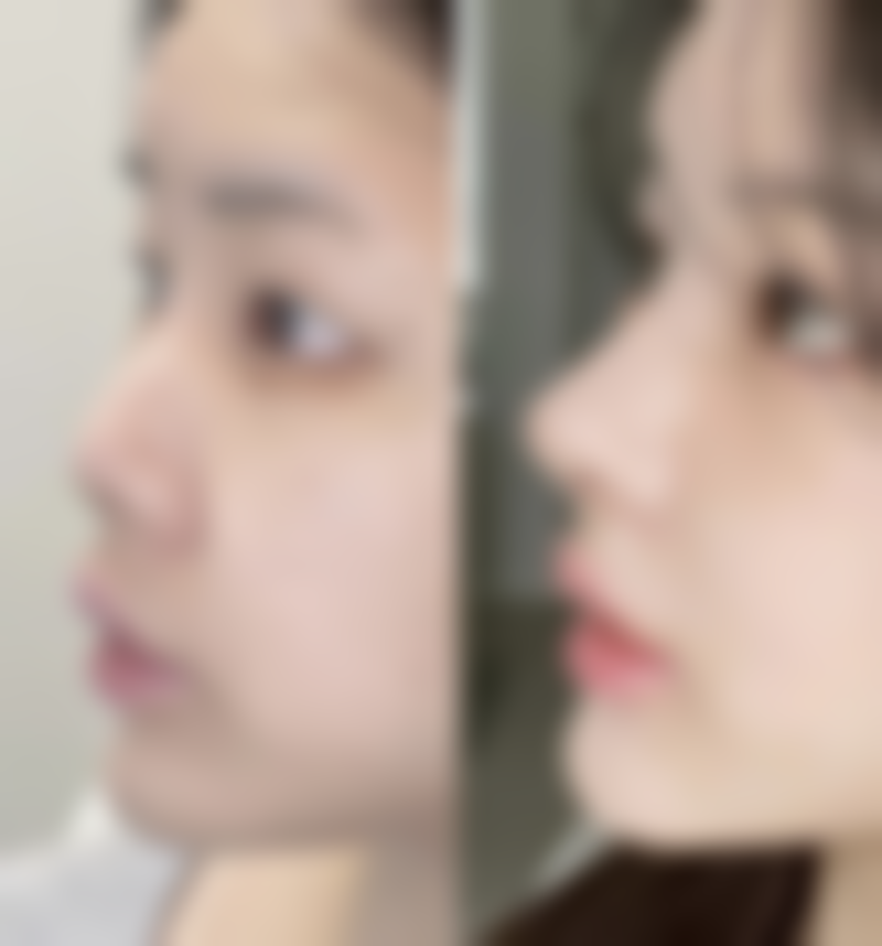 牙齿矫正可以只矫正下面一排吗