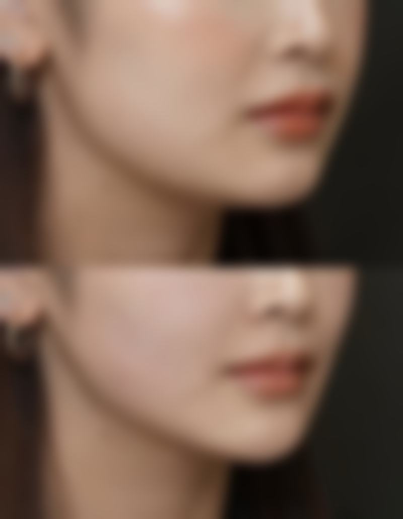 毛发种植多长时间有效果？了解不同阶段恢复周期，毛囊植入后3 - 6个月显著变化揭秘！ 