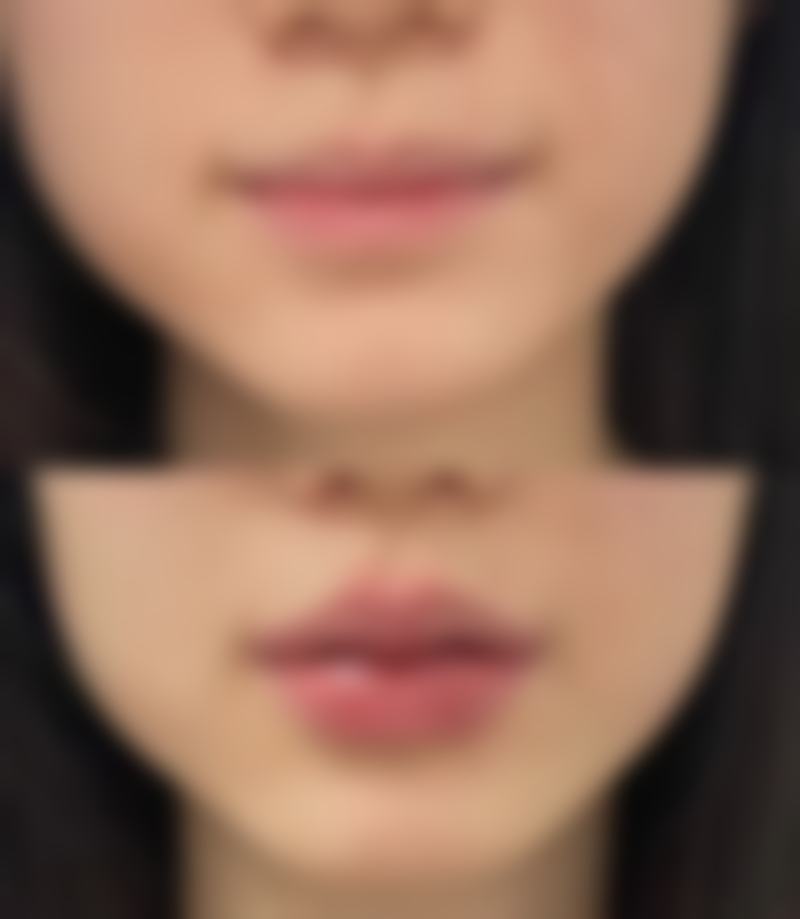 瘦脸针打后需要注意什么？牢记这5点护理秘诀，助你快速恢复并拥有持久精致小脸！ 