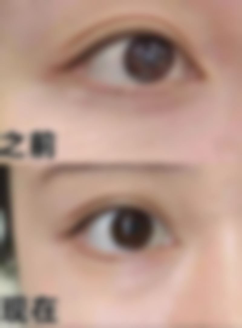 牙齿矫正需要终身佩戴矫正器吗