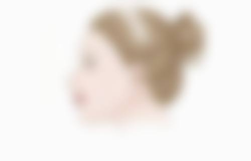 玻尿酸填充的注意事项