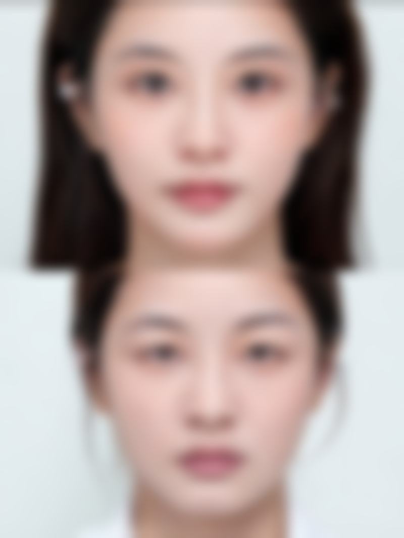 玻尿酸丰太阳穴几天能好？了解恢复时间规律，3大护理要点助你7天快速消肿恢复自然美 