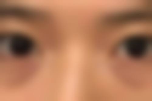 种植发际线是什么意思？它是重塑完美脸型的医美妙招，90%的人做完都说颜值提升了一大截！ 