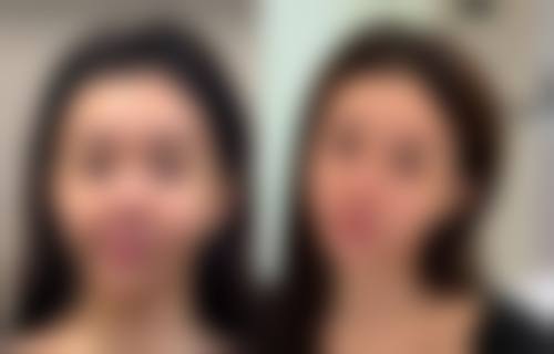 种植头发的危害和后遗症