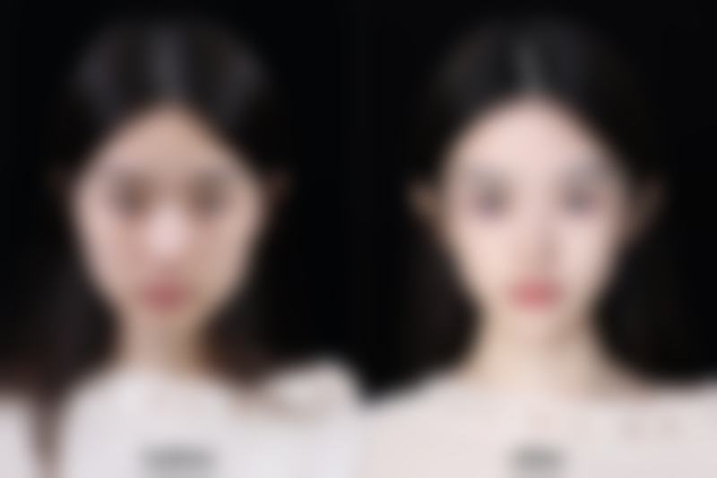 阴道紧缩术后多久可以怀孕