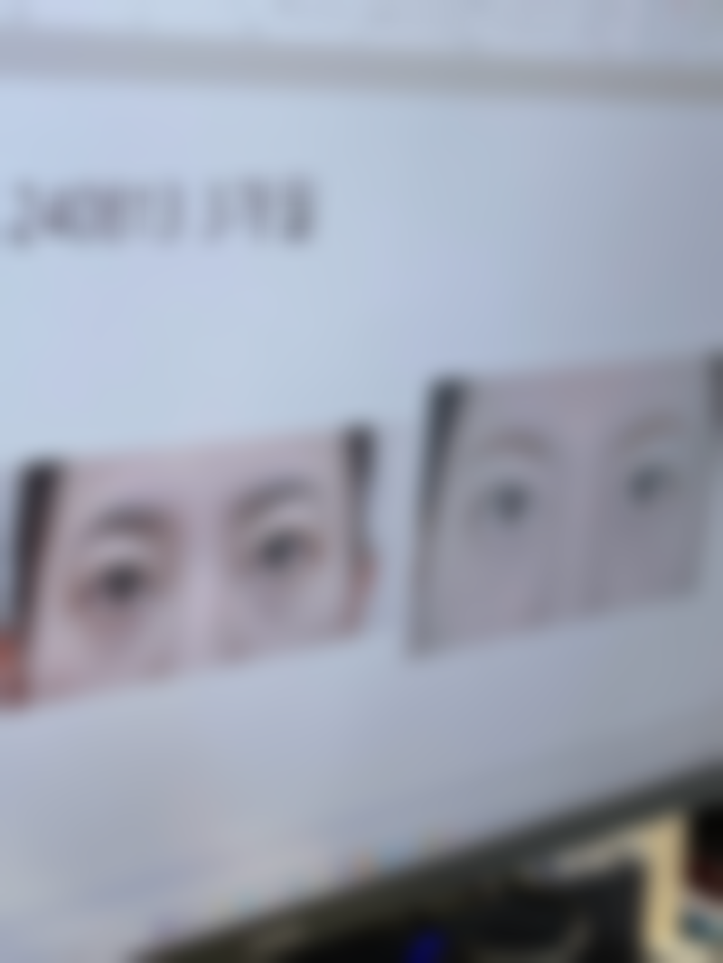 头发种植术植发一般价格