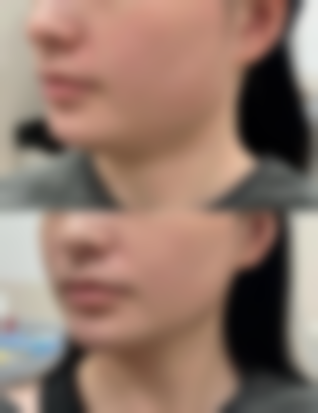 瘦脸针多久打一次可以维持恒久