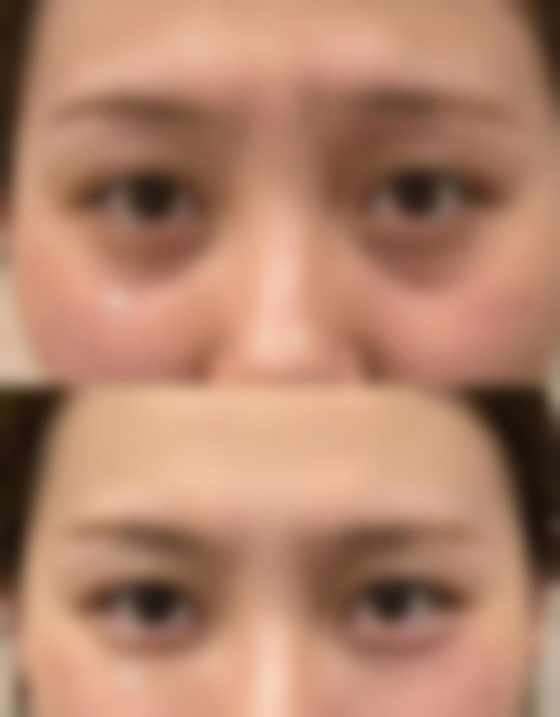 瘦脸针间隔多久打一次更好