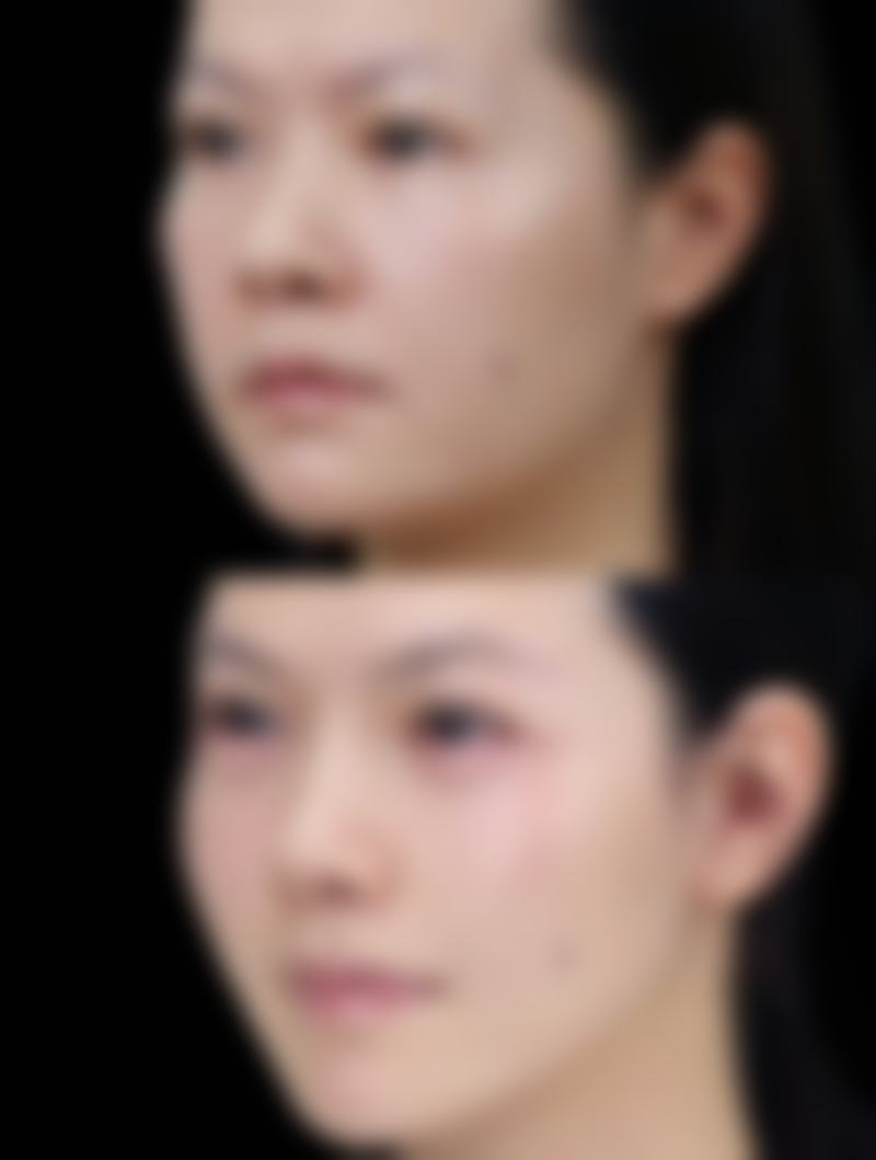 种植发际线成功几率高吗