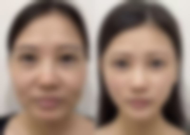 多久打一次瘦脸针合适