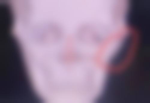 瘦脸针可以自己买回来打吗女生