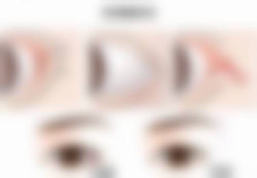 不同阴道紧缩术的具体方式