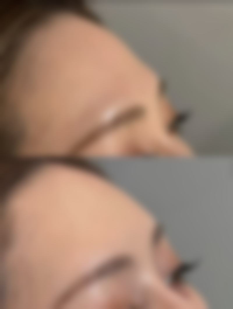 除了自体脂肪丰太阳穴，还有其他方法吗？