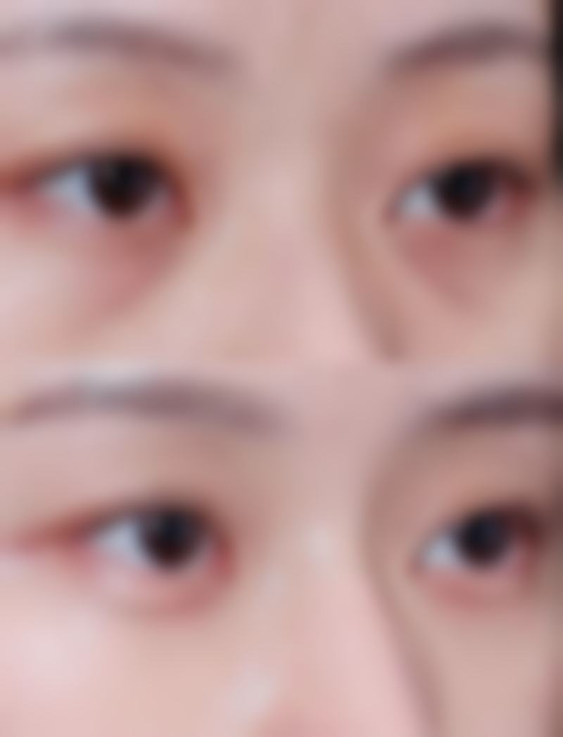 自体脂肪丰太阳穴的价格与适用人群