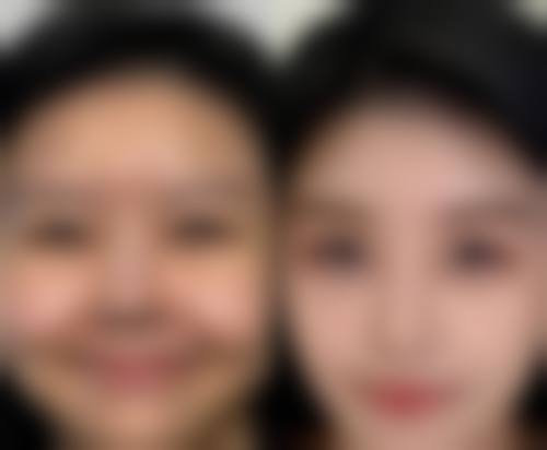 微整可以把嘴巴弄小点吗？揭秘3种效果显著的微整方式，让你轻松拥有小巧迷人嘟嘟唇！ 