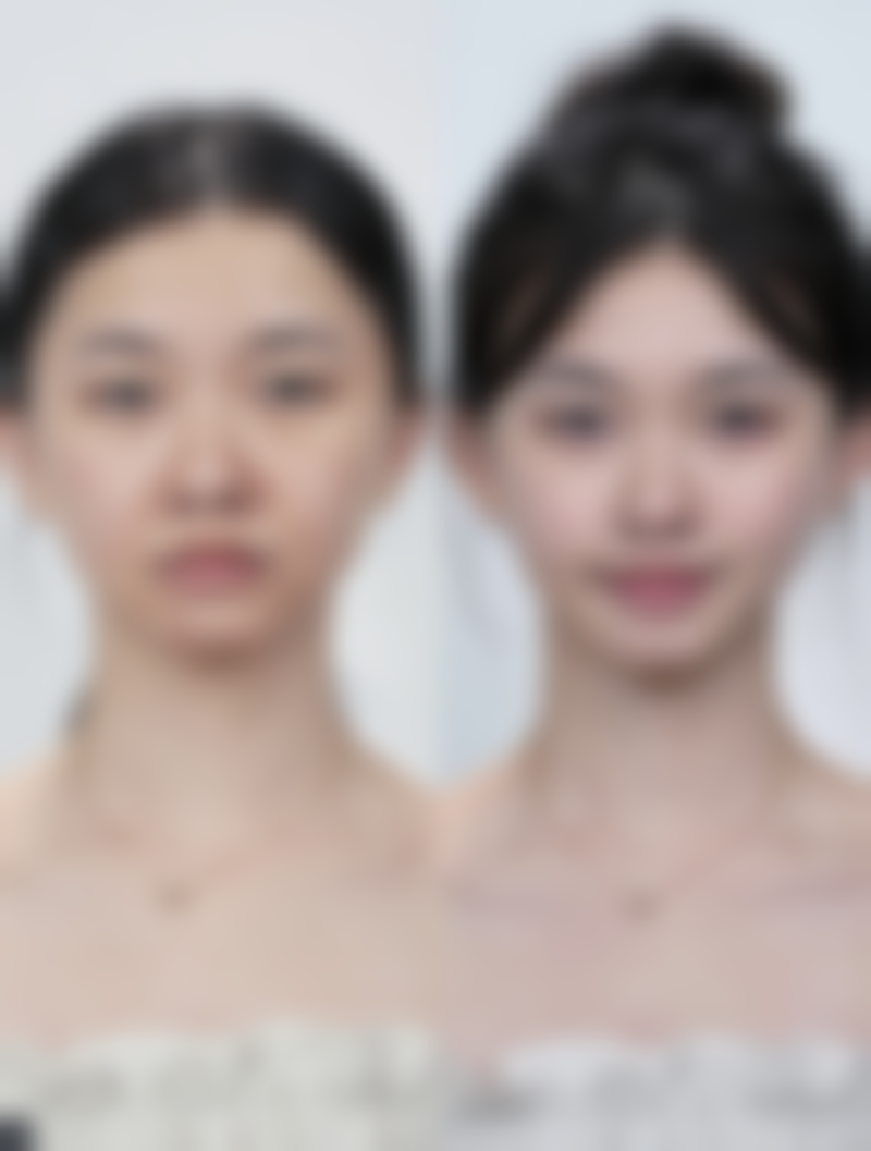 为什么打完瘦脸针感觉脸更大了？原来是这些原因在作祟！3步教你破解“脸大”谜团，速来get！ 