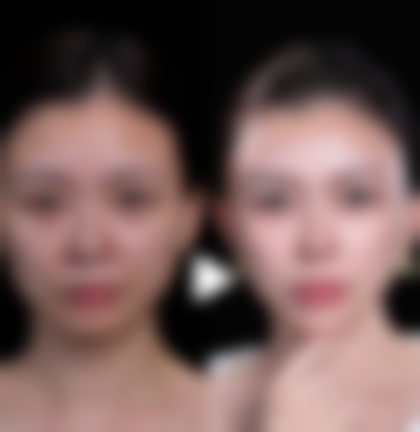 为什么打了瘦脸针后脸部会下垂