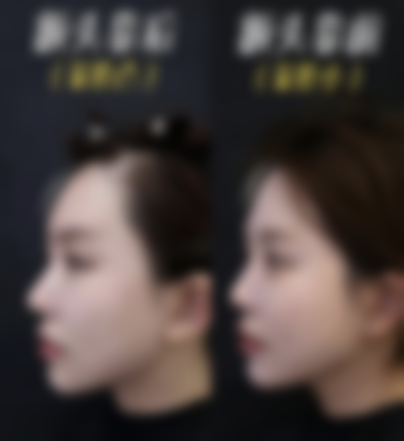 六、瘦脸治疗后的注意事项